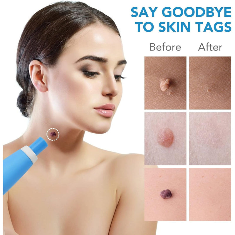 Skin Tag Remover Kit 2 in 1 for Micro to Large